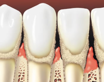 Rotting Gums Periodontal Disease | Miles Dental