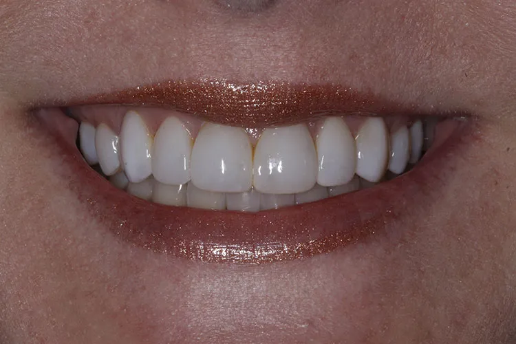 composite veneers 1 After