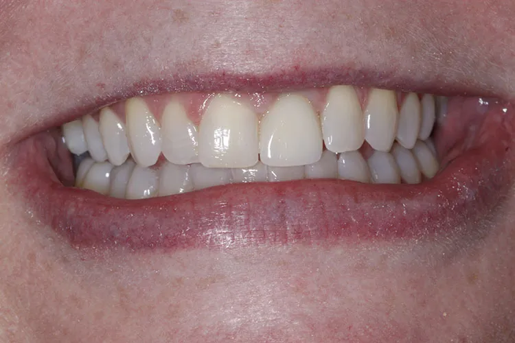implant crown front tooth after