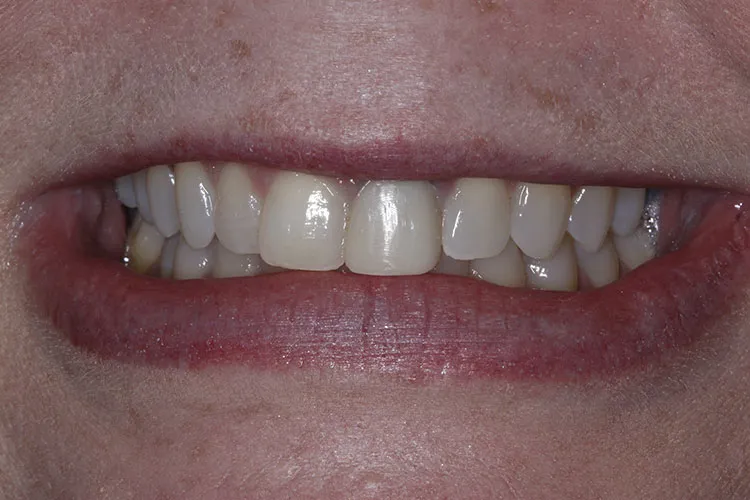 implant crown front tooth before