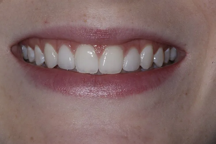 porcelain crowns 1 After