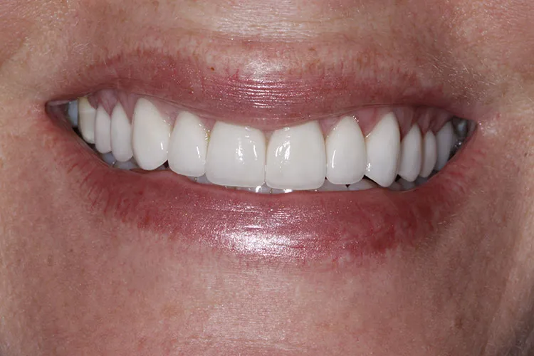 porcelain veneers 1 After