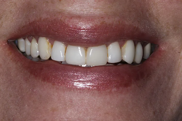 porcelain veneers 1 Before