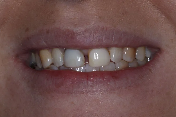 porcelain veneers 2 Before